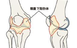 膝の下側の痛み（膝蓋下脂肪体）