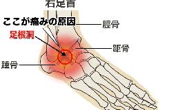 捻挫は治ったはずなのに足首が痛い…足首のセンサーのバグ「足根洞症候群」とは?