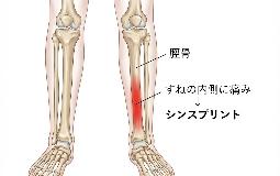 部活、ランニング、ダンスなどで起きる脛の痛み「シンスプリント」について