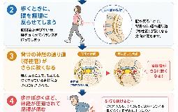 「脊柱管狭窄症」はなぜ歩くと症状が出るの？